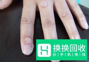 治疗瘊子 寻常疣的各种偏方汇总