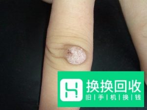 治疗瘊子 寻常疣的各种偏方汇总

